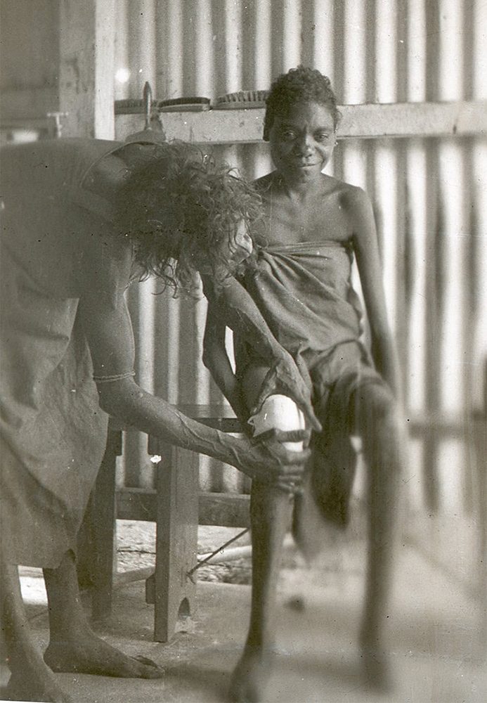 Leprosy patient in 1952 Leprosy patient in 1952